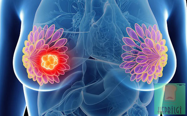 En Çok Rastlanan Meme Kanseri Belirtileri - 3