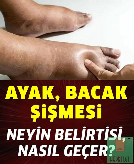Ayak Bacak Şişmesi Neyin Belirtisi - 1