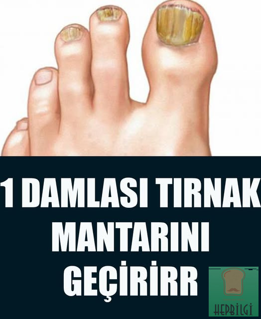 Basit Bir Yöntemle Tırnak Mantarından Kurtulun - 1