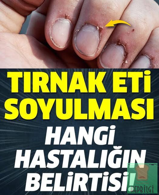 Tırnak Soyulması Hangi Hastalığın Belirtisi - 1