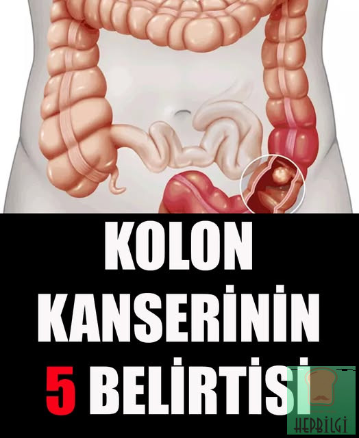 Kolon Kanserinin 5 Belirtisi - 1