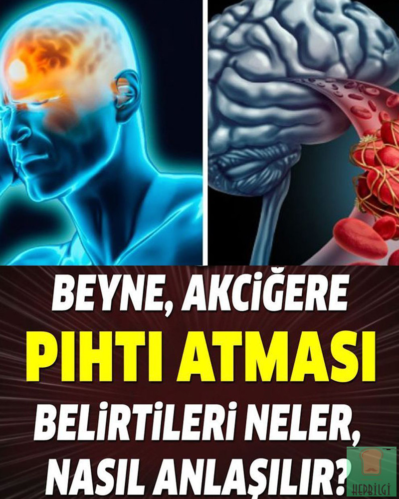 Pıhtı Atması Belirtileri Nelerdir - 1