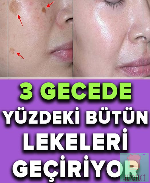 İki Malzemeli Bu Tarif Yüzünüzdeki Lekeleri 3 Gecede Geçiriyor - 1