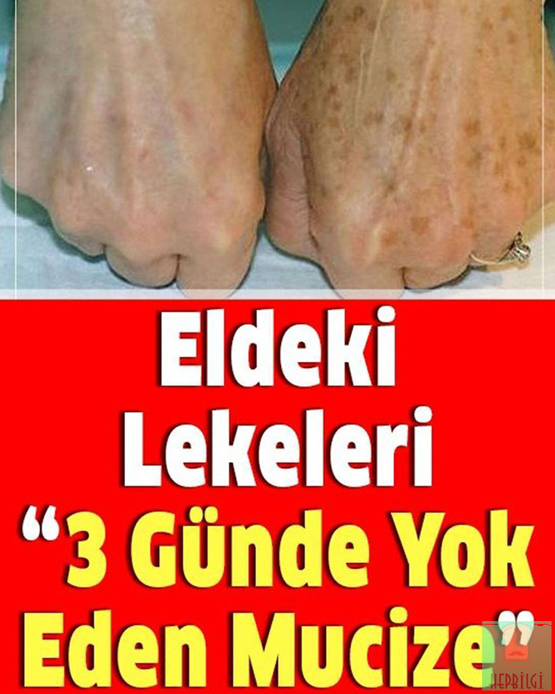 Eldeki lekeleri 3 günde yok eden mucize - 1