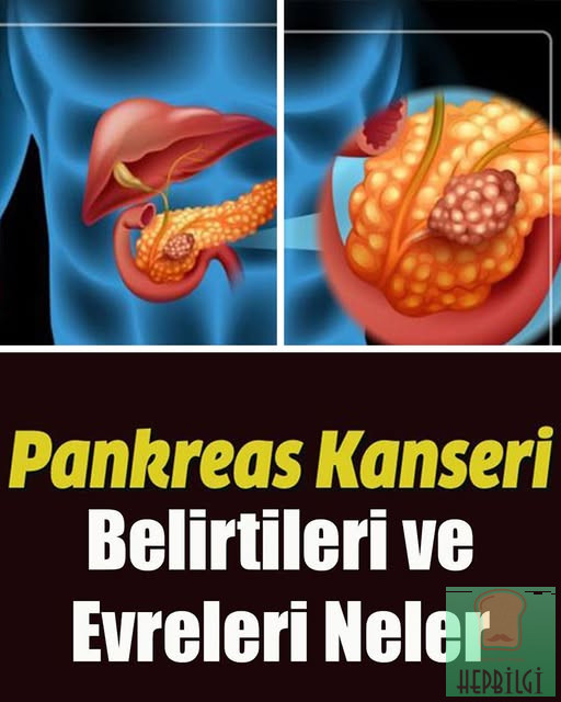 Pankreas Kanseri Belirtileri ve Evreleri Neler - 1