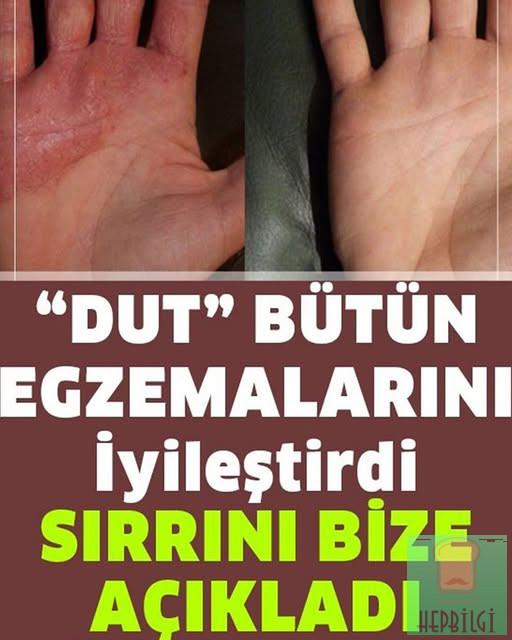 Egzamadan Kurtaran En İyi Doğal Tedavi - 1