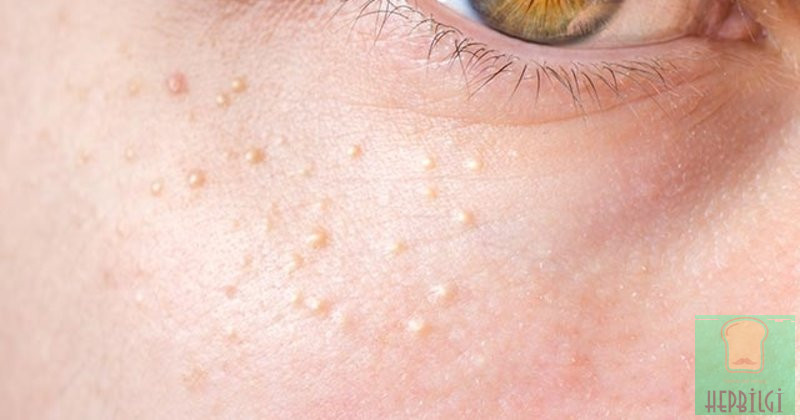 Yağ Bezelerini Geçirmenin En Etkili Yolları - 3