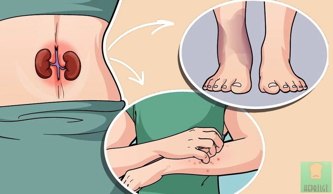Böbrek Yetmezliğinin 10 Erken Belirtisi - 3