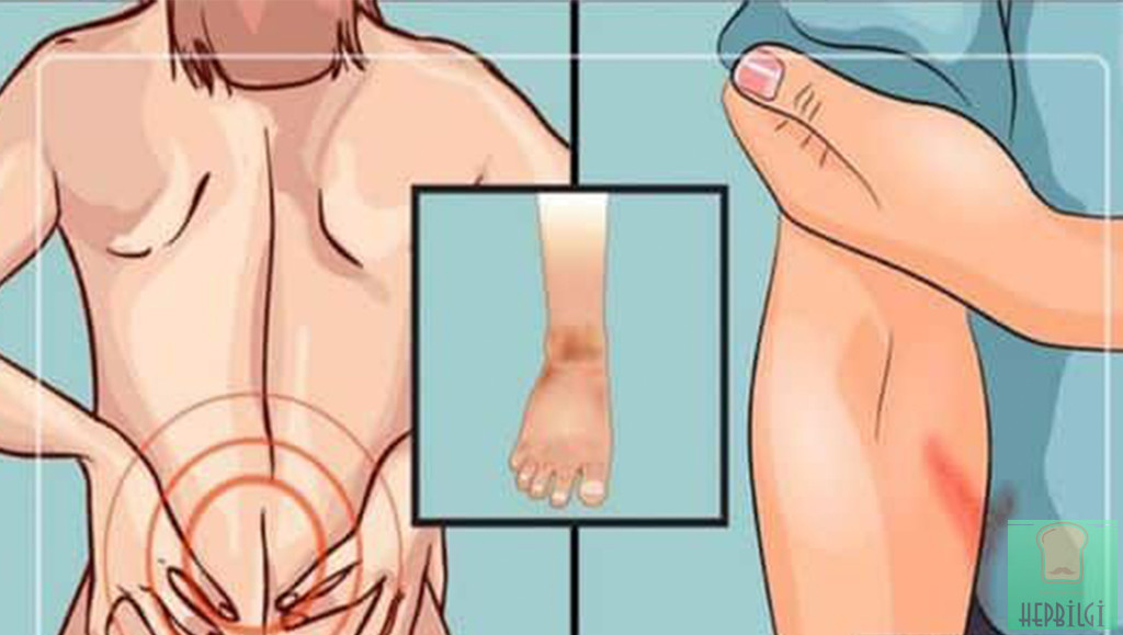 Böbrek Kanseri Bu Belirtiler İle Sizi Uyarıyor - 3