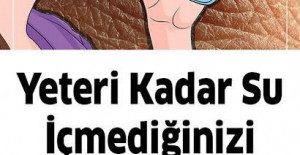 Yeteri kadar su içmediğinizde başınıza bunlar gelir.. >>