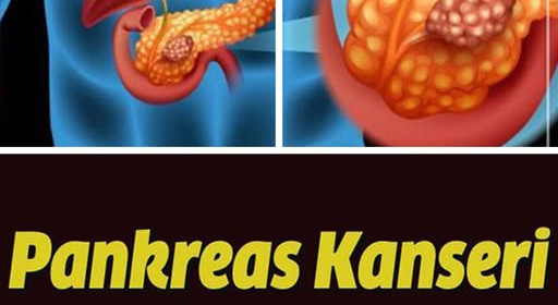 Pankreas Kanseri Belirtileri ve Evreleri Neler 