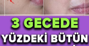 İki Malzemeli Bu Tarif Yüzünüzdeki Lekeleri 3 Gecede Geçiriyor 