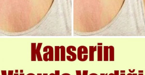 Kanserin Vücuda Verdiği 10 Belirti