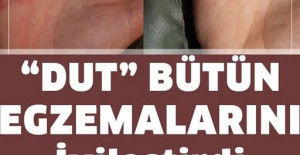 Egzamadan Kurtaran En İyi Doğal Tedavi