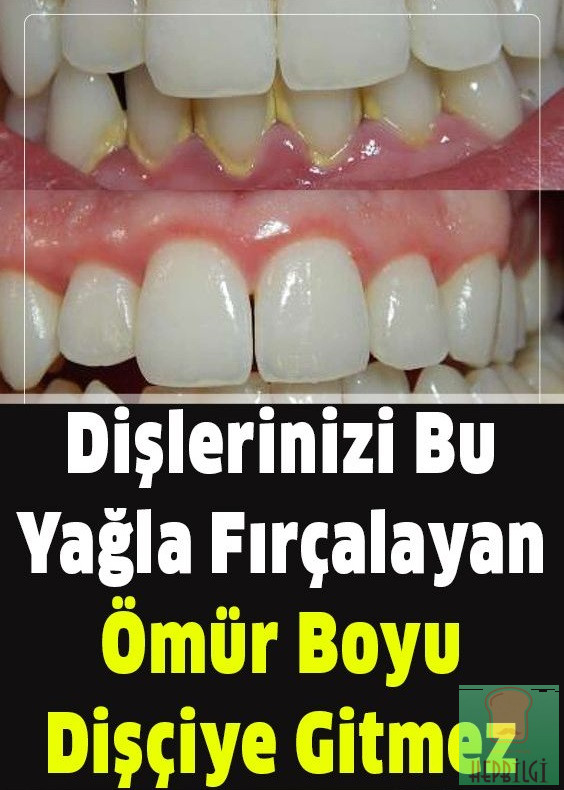 40 SENE DÜŞÜNSENİZ AKLINIZA BİLE GELMEZ DİŞTEKİ PLAĞI TARTARI YOK EDİYOR - 2
