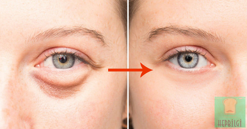 Karbonat İle 10 Yaş Genç Görünün - 3