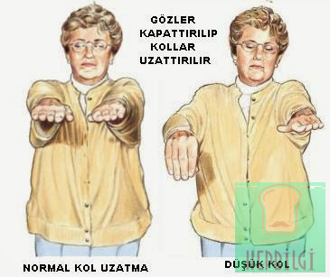 Felç geçirmeden evvel ortaya çıkan belirtiler - 3