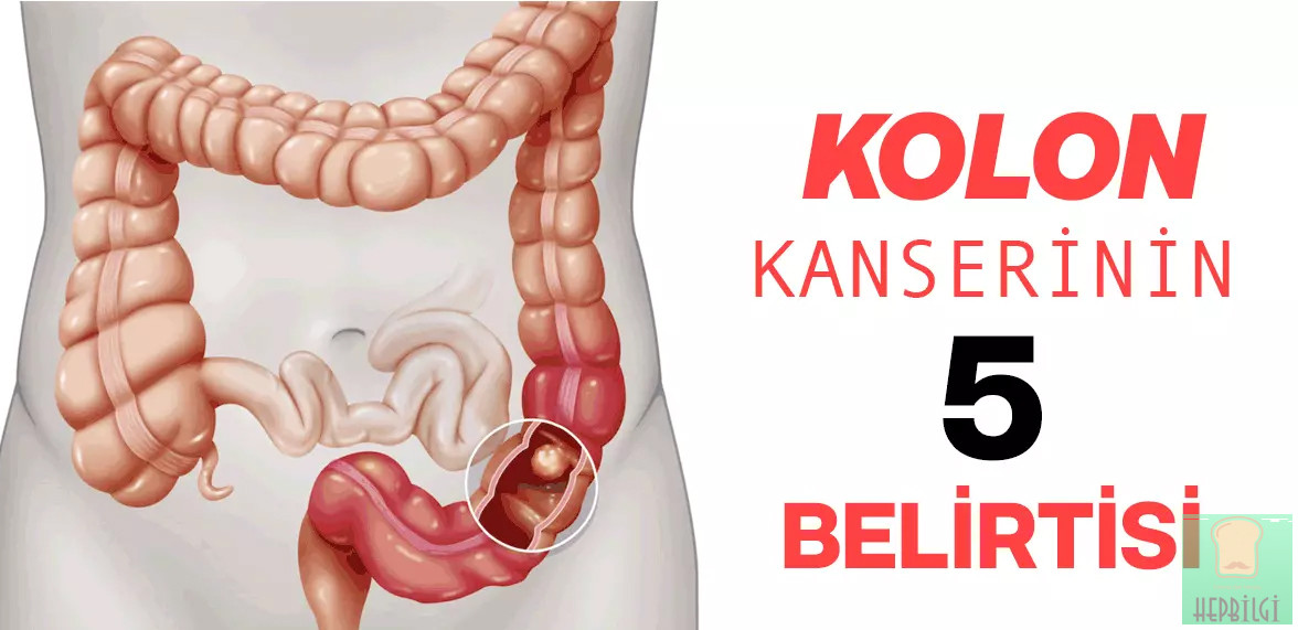 Kolon Kanserinin 5 Belirtisi - 2